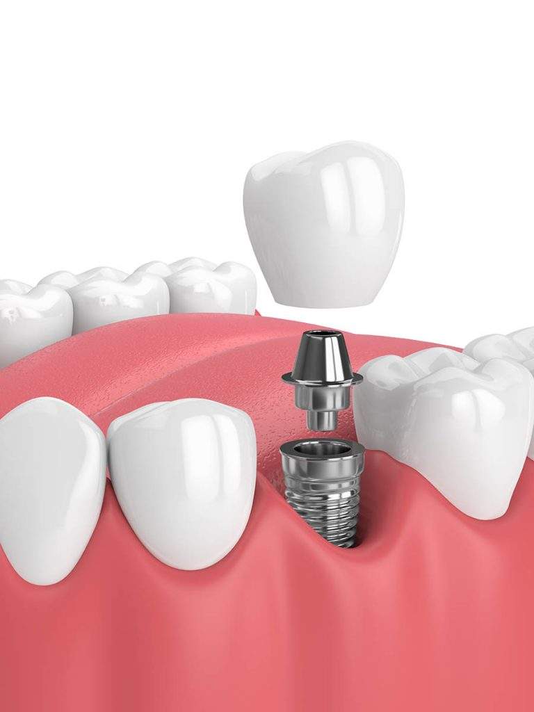 Implantes dentales con financiación en Paracuellos del Jarama-Cobeña